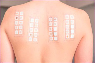 Institut Dermatològic Girona tratamiento sobre espalda